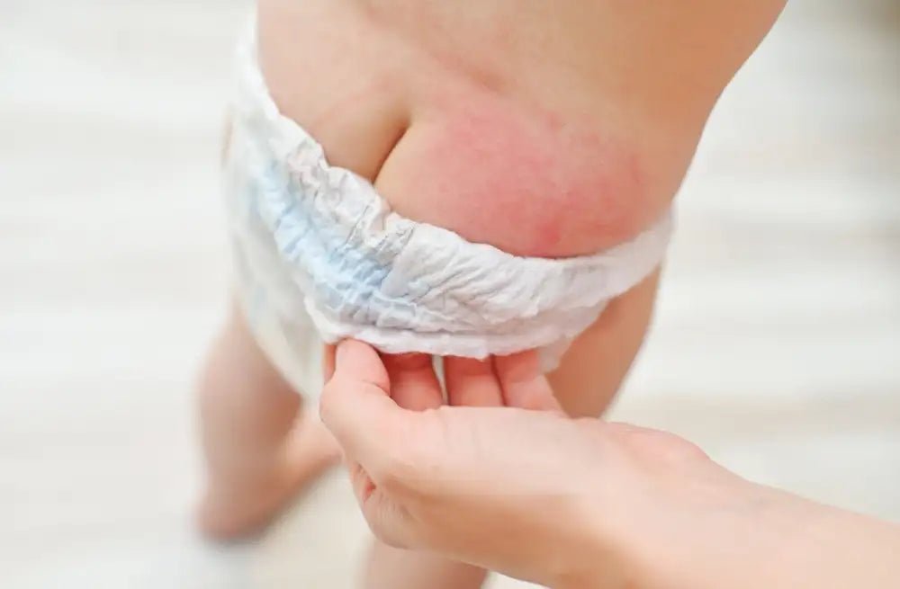 Title: The Ultimate Guide to Diaper Rash: Causes, Prevention, and Treatment